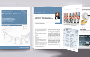 Professor Gang Shen's Orthodontic Team Publishes Third Consecutive Paper in the Journal of Aligner Orthodontics